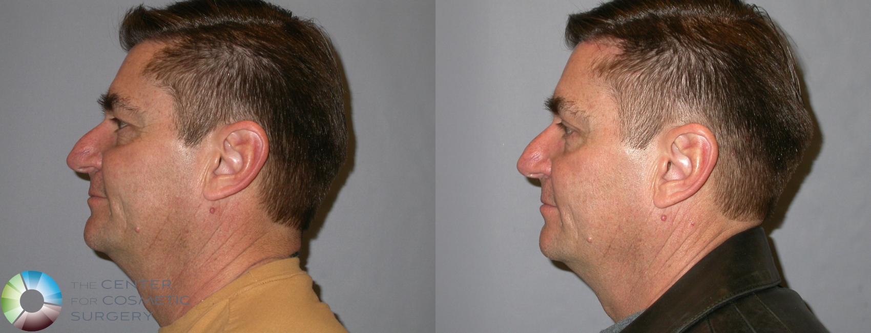 Before & After Eyelid Lift Case 257 View #3 in Denver and Colorado Springs, CO