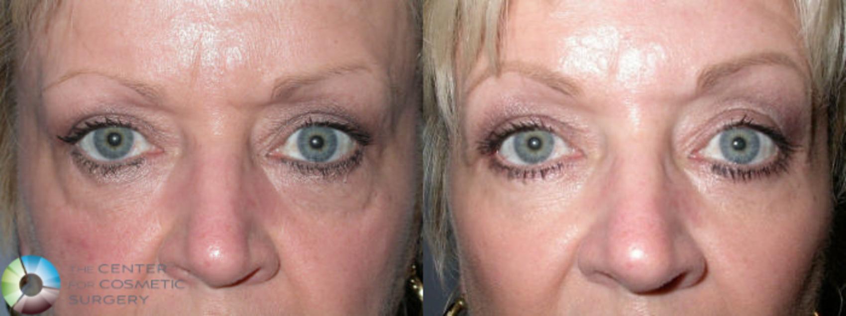 Before & After Eyelid Lift Case 3 View #1 View in Golden, CO