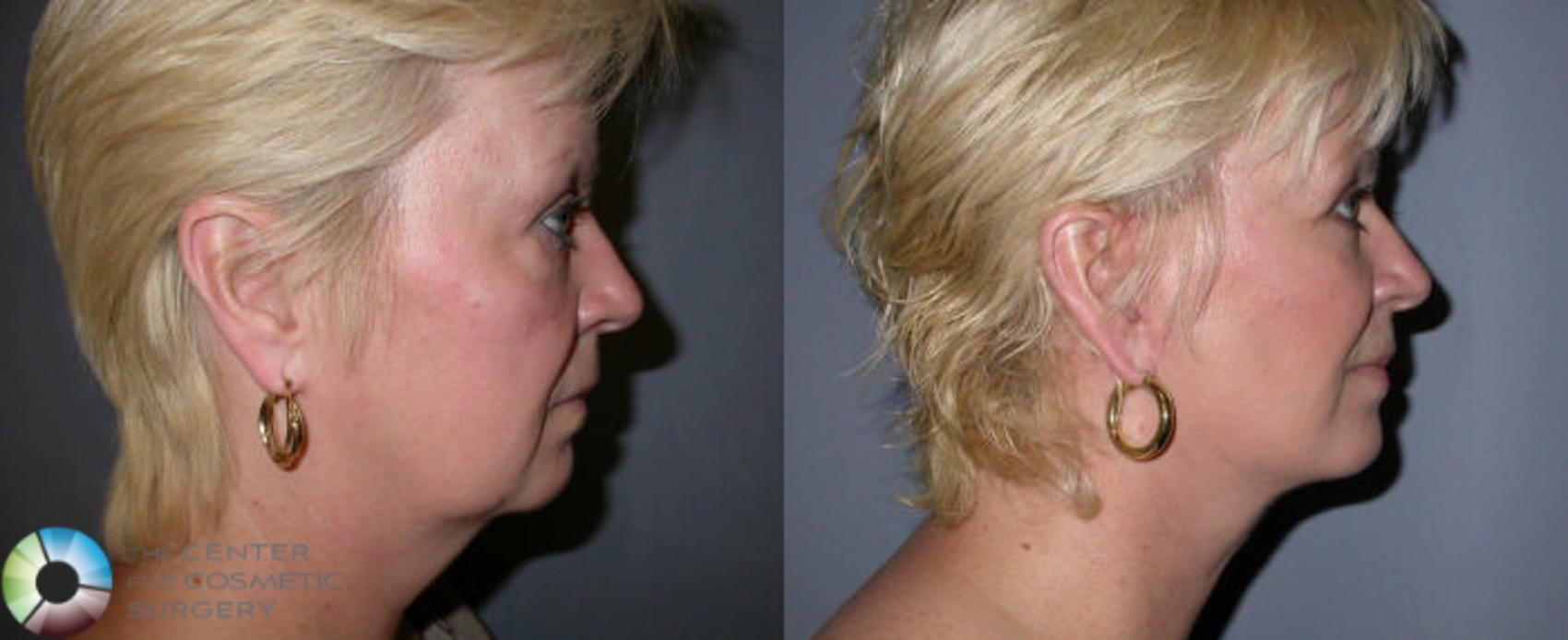 Before & After Eyelid Lift Case 3 View #3 View in Golden, CO