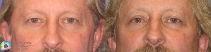 Before & After Eyelid Lift Case 304 View #1 View in Golden, CO