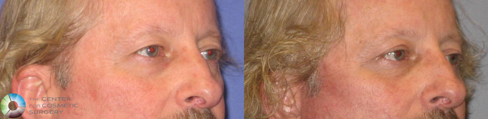 Before & After Eyelid Lift Case 304 View #2 in Denver and Colorado Springs, CO