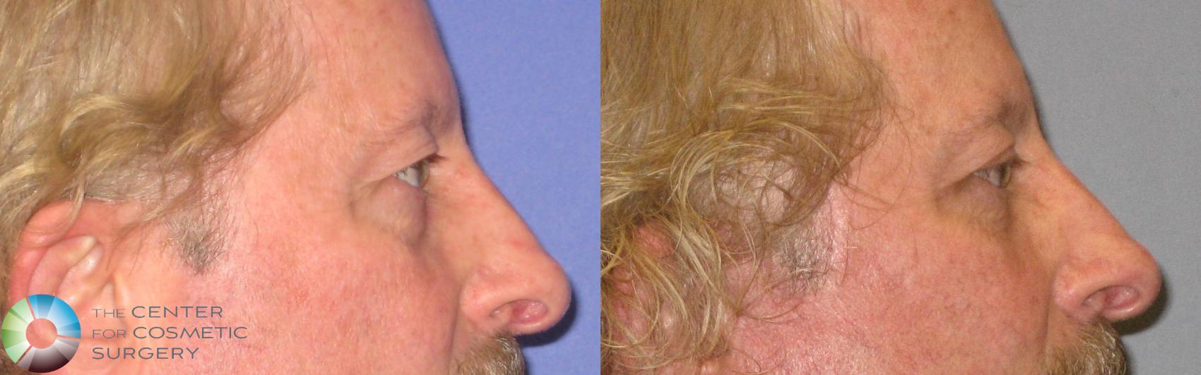 Before & After Eyelid Lift Case 304 View #3 in Denver and Colorado Springs, CO