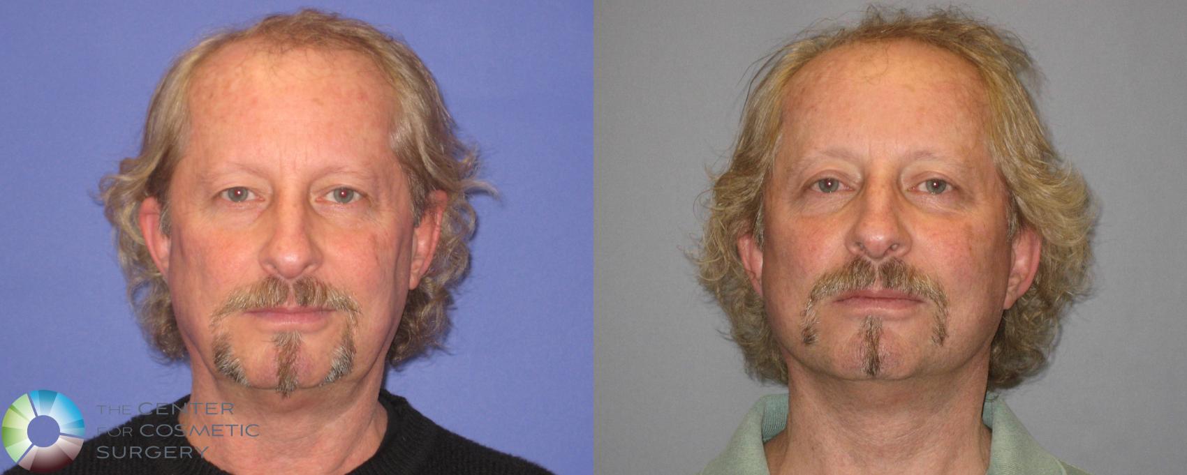 Before & After Eyelid Lift Case 304 View #4 in Denver and Colorado Springs, CO