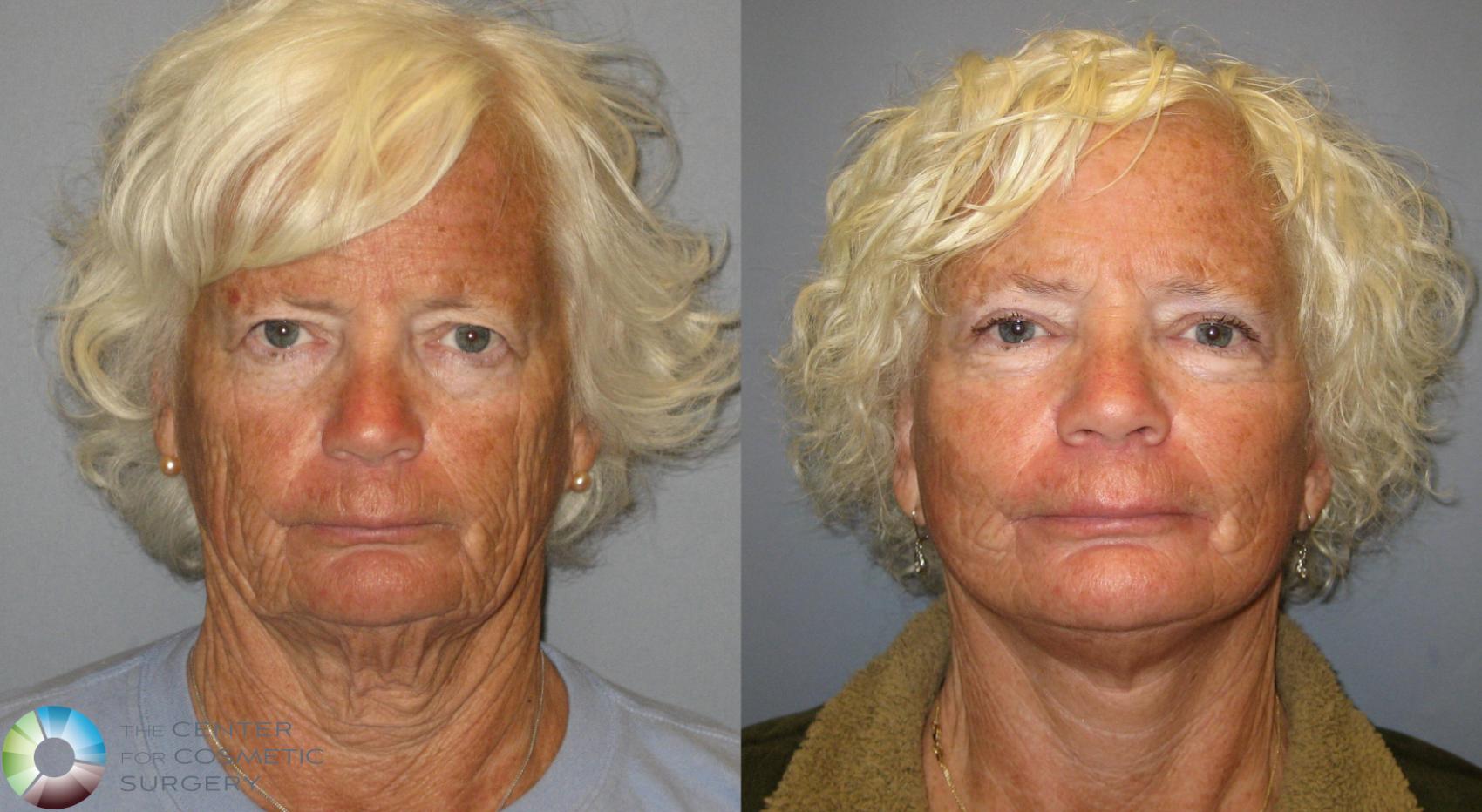 Before & After Mini Facelift Case 388 View #1 in Denver and Colorado Springs, CO