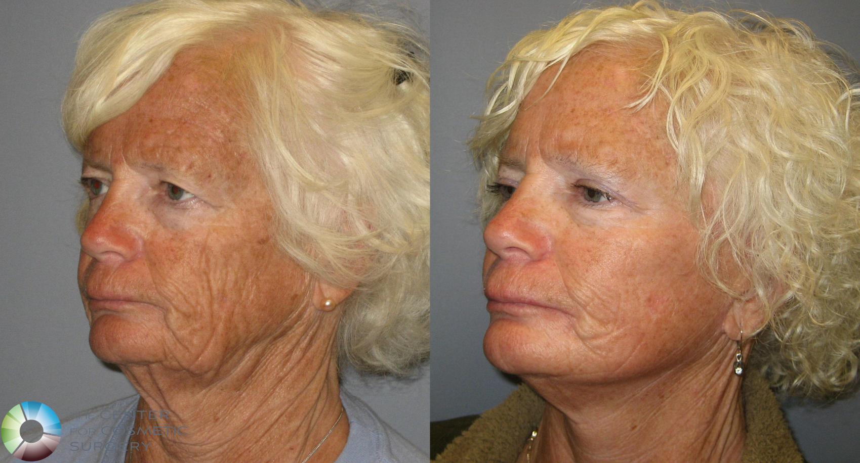 Before & After Eyelid Lift Case 388 View #2 View in Golden, CO