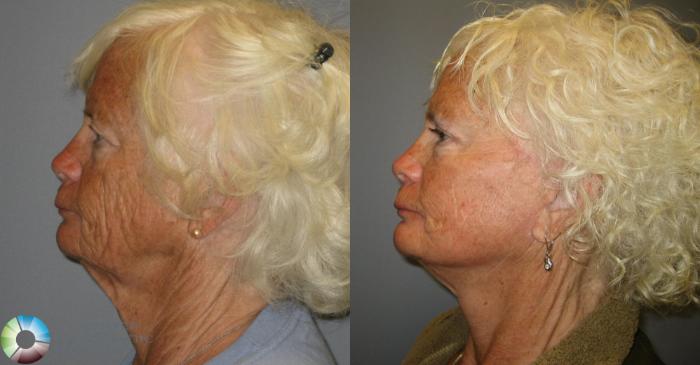 Before & After Mini Facelift Case 388 View #3 View in Golden, CO