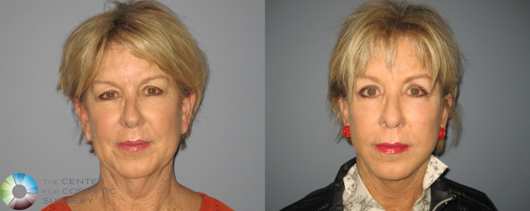 Before & After Facelift Case 461 View #1 in Denver and Colorado Springs, CO