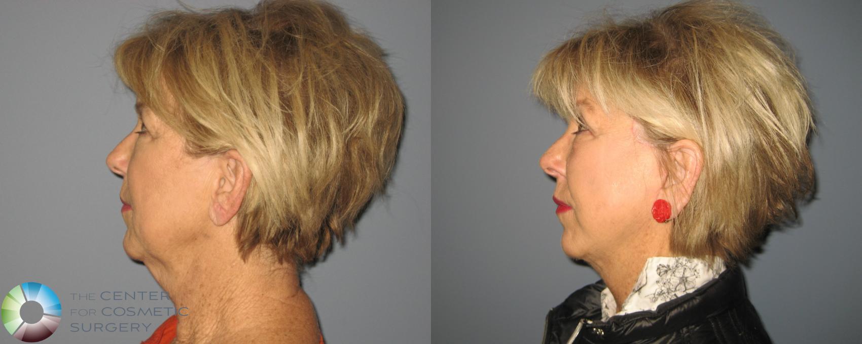 Before & After Eyelid Lift Case 461 View #2 View in Golden, CO