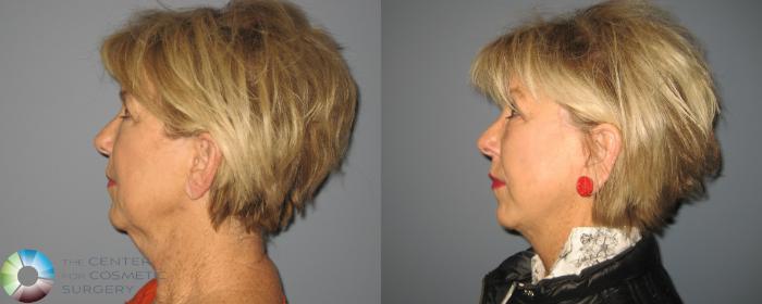 Before & After Mini Facelift Case 461 View #2 View in Golden, CO