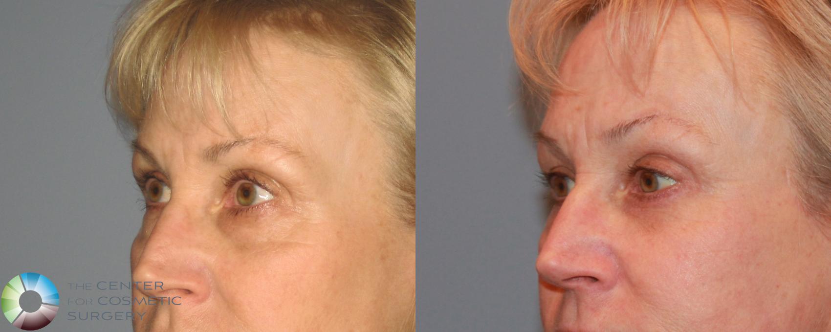 Before & After Eyelid Lift Case 494 View #2 in Denver and Colorado Springs, CO