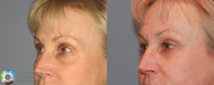 Before & After Eyelid Lift Case 494 View #2 View in Golden, CO