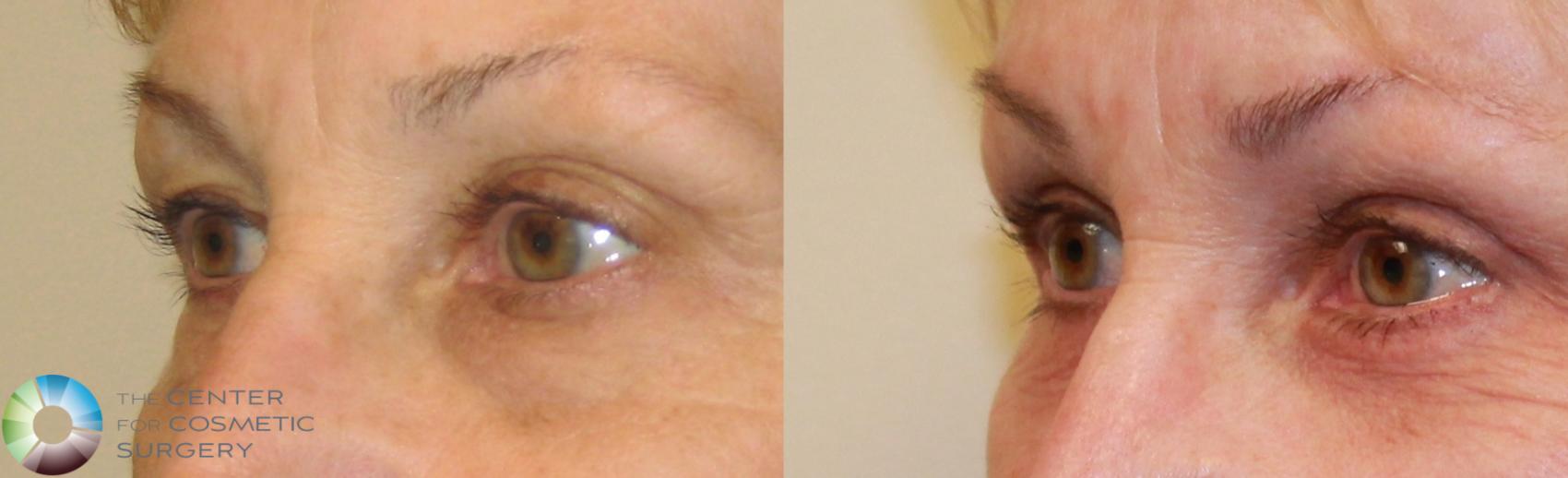 Before & After Eyelid Lift Case 494 View #3 View in Denver & Golden, CO