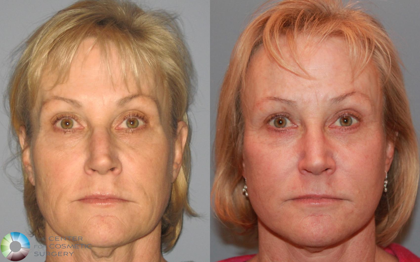 Before & After Eyelid Lift Case 494 View #4 View in Denver & Golden, CO