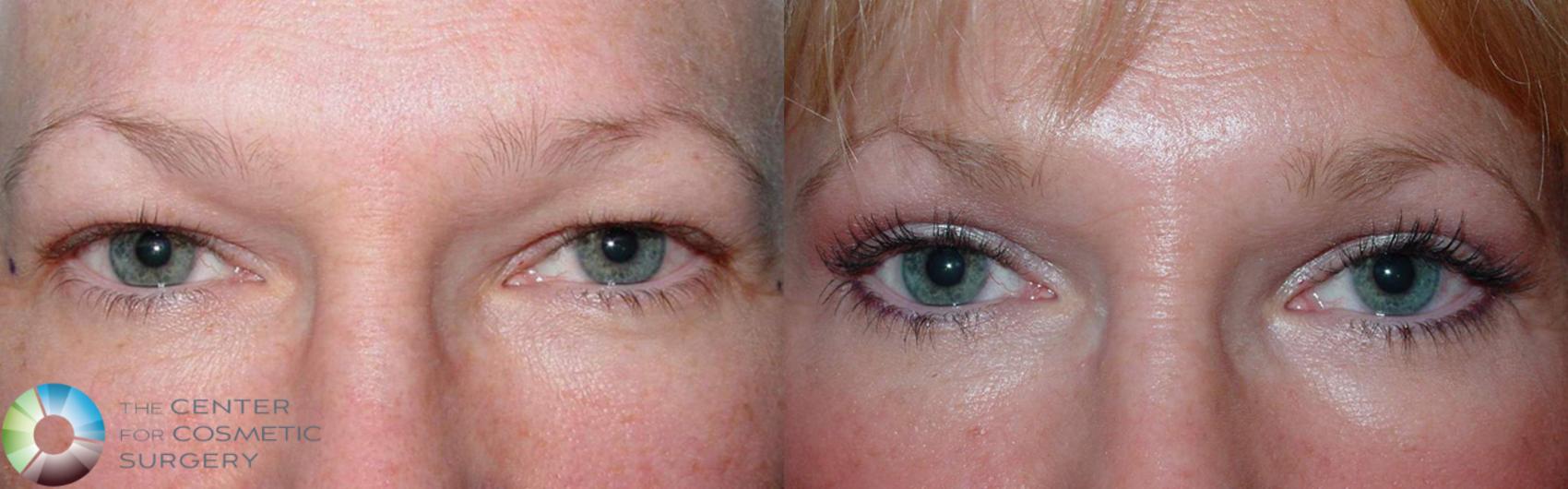 Before & After Eyelid Lift Case 497 View #1 in Denver and Colorado Springs, CO