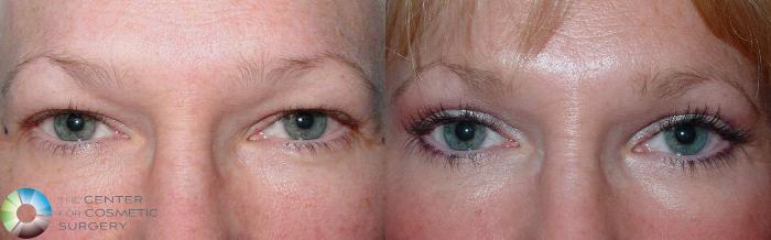 Before & After Eyelid Lift Case 497 View #1 in Denver and Colorado Springs, CO