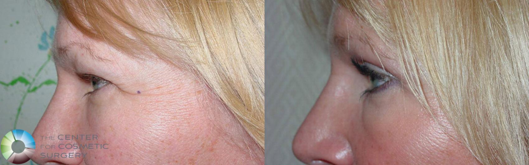 Before & After Eyelid Lift Case 497 View #2 View in Golden, CO