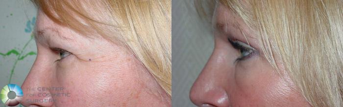Before & After Eyelid Lift Case 497 View #2 in Denver and Colorado Springs, CO