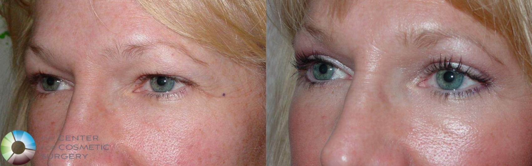 Before & After Eyelid Lift Case 497 View #3 View in Golden, CO