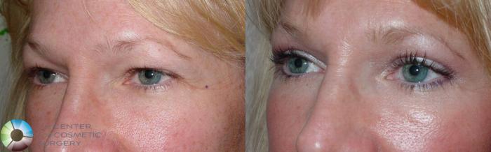 Before & After Eyelid Lift Case 497 View #3 in Denver and Colorado Springs, CO