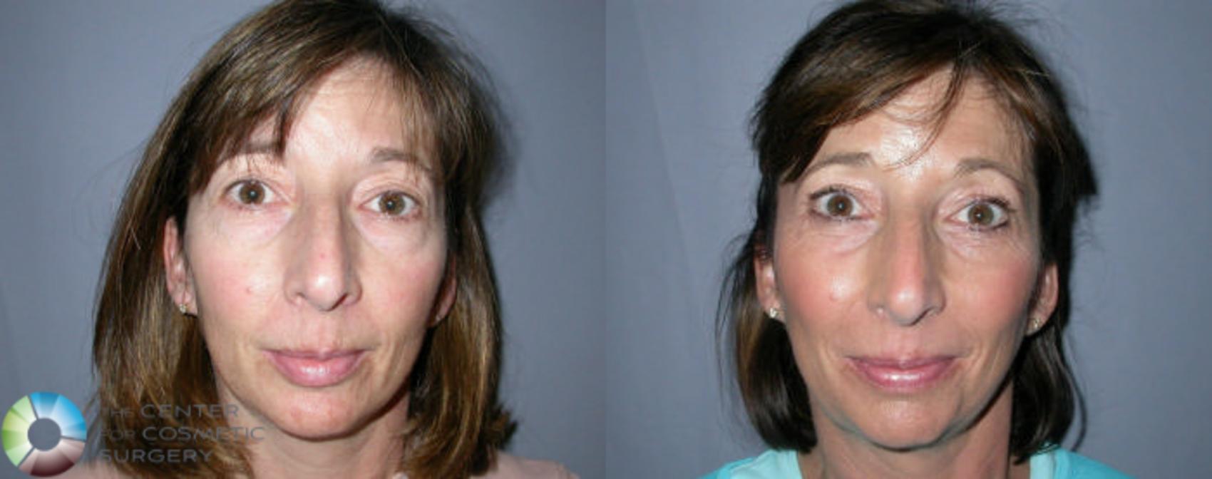 Before & After Eyelid Lift Case 52 View #1 View in Golden, CO