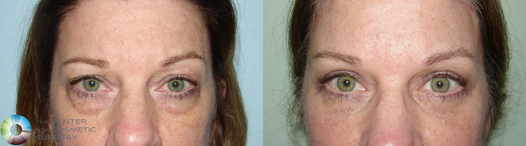 Before & After Eyelid Lift Case 532 View #1 in Denver, CO