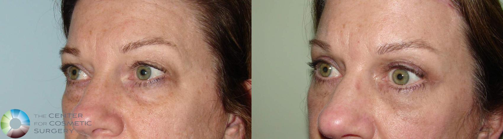 Before & After Eyelid Lift Case 532 View #2 View in Denver & Golden, CO