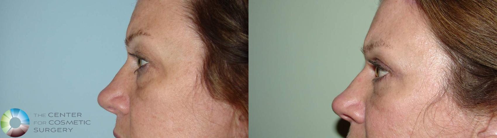 Before & After Eyelid Lift Case 532 View #3 View in Denver & Golden, CO