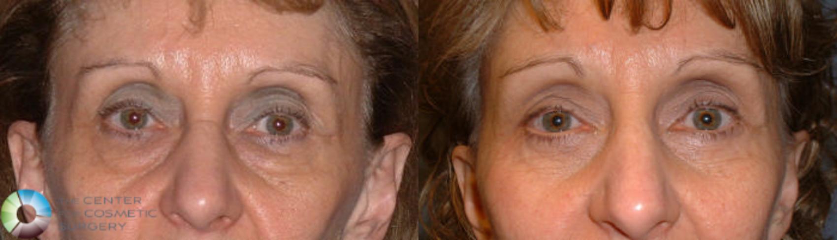 Before & After Eyelid Lift Case 56 View #1 in Denver and Colorado Springs, CO