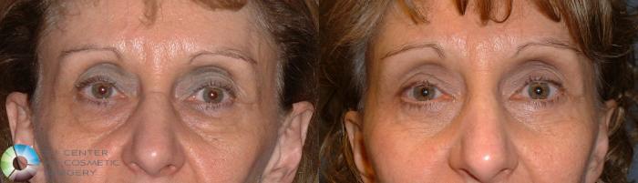 Before & After Eyelid Lift Case 56 View #1 View in Golden, CO