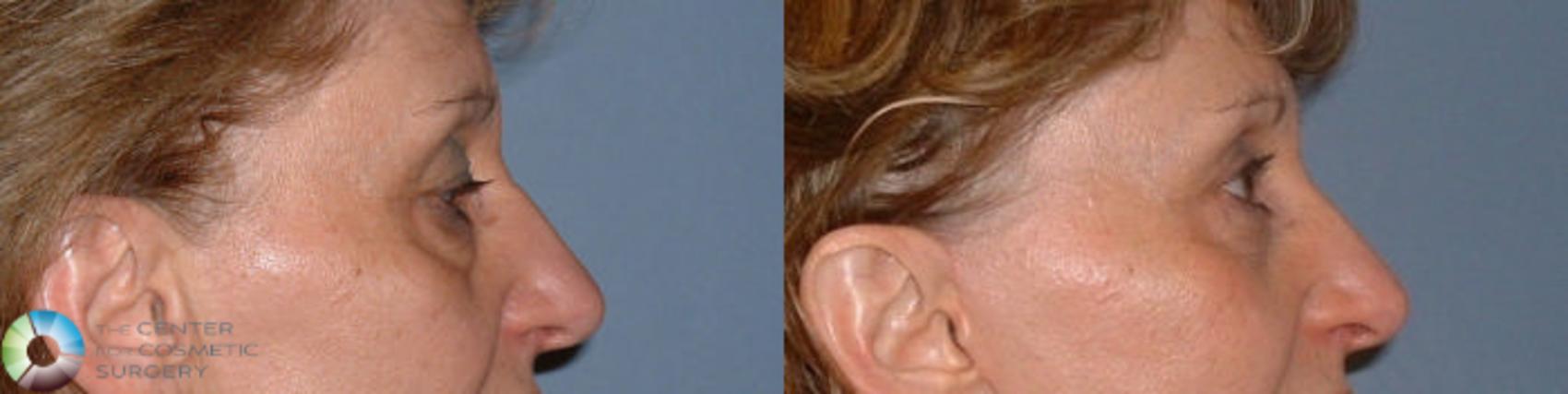 Before & After Eyelid Lift Case 56 View #3 in Denver and Colorado Springs, CO