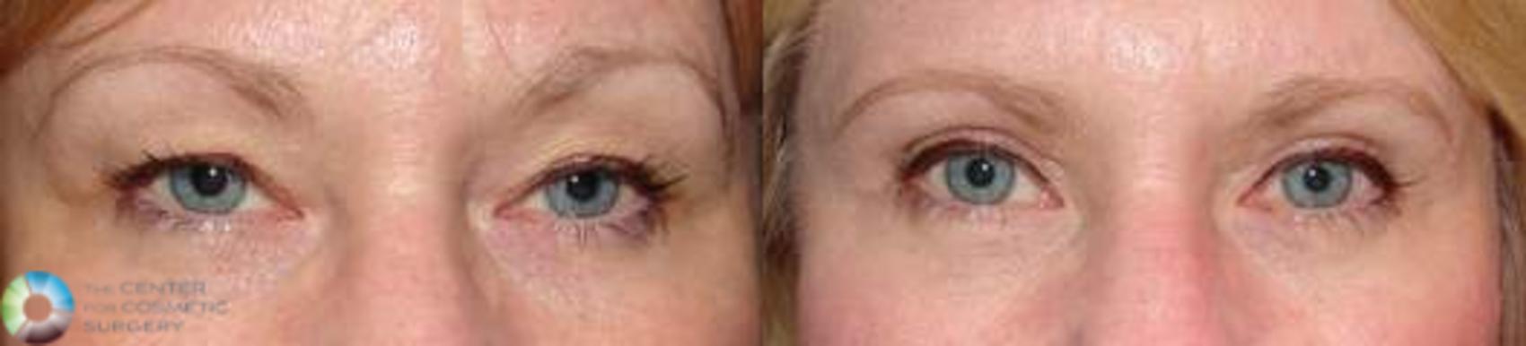 Before & After Eyelid Lift Case 577 View #1 in Denver and Colorado Springs, CO