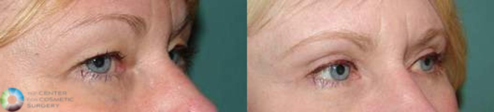Before & After Eyelid Lift Case 577 View #2 View in Denver & Golden, CO