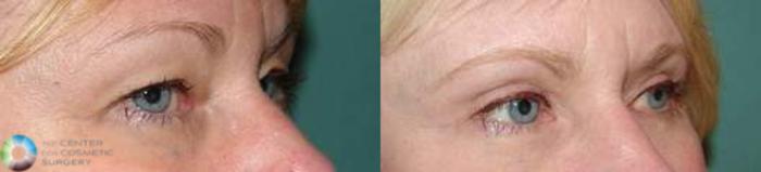 Before & After Eyelid Lift Case 577 View #2 View in Golden, CO