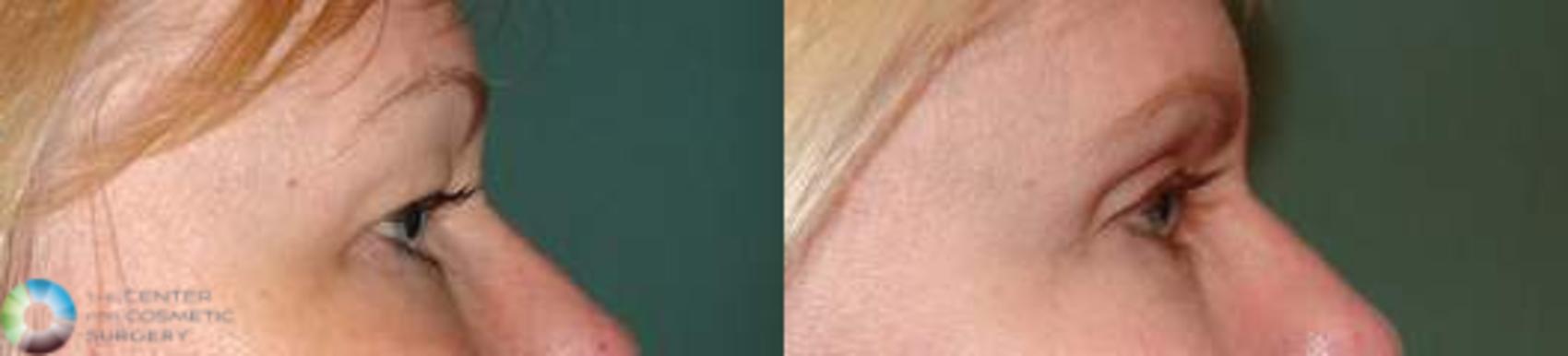 Before & After Eyelid Lift Case 577 View #3 View in Denver & Golden, CO