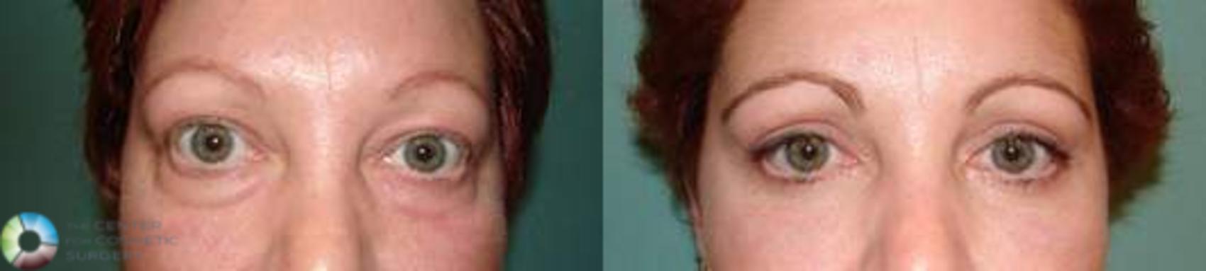 Before & After Eyelid Lift Case 578 View #1 in Denver and Colorado Springs, CO