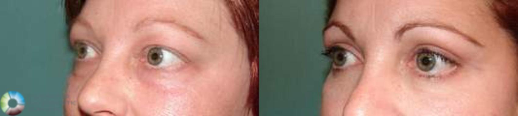 Before & After Eyelid Lift Case 578 View #2 View in Golden, CO