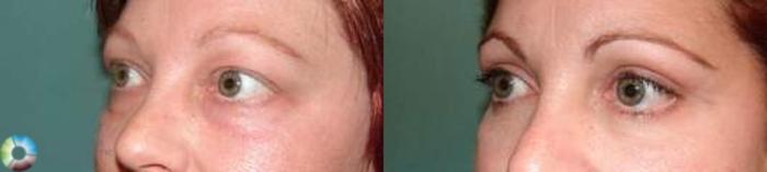Before & After Eyelid Lift Case 578 View #2 in Denver and Colorado Springs, CO