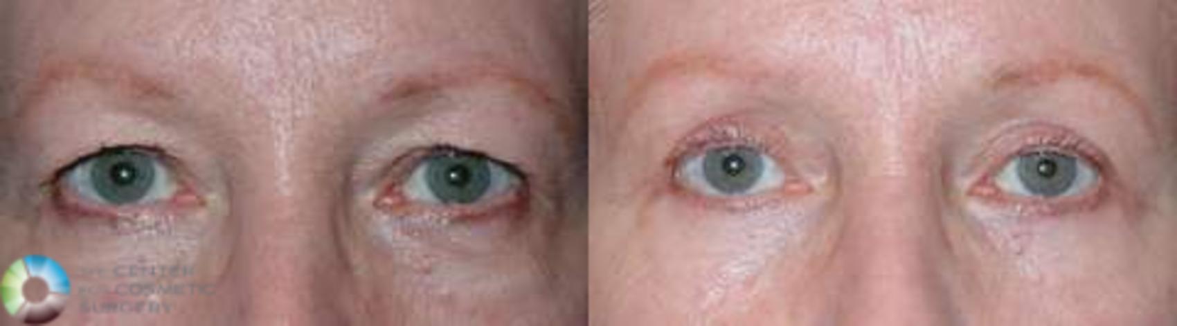 Before & After Eyelid Lift Case 579 View #1 View in Golden, CO