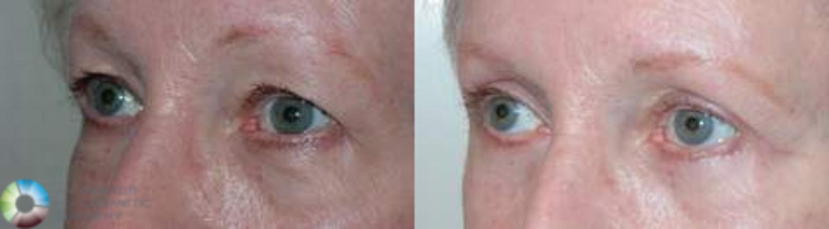 Before & After Eyelid Lift Case 579 View #2 View in Golden, CO