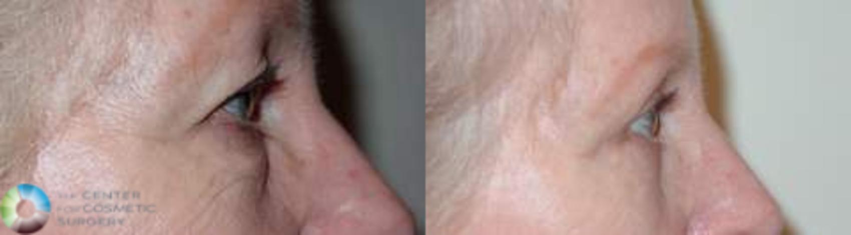 Before & After Eyelid Lift Case 579 View #3 View in Golden, CO