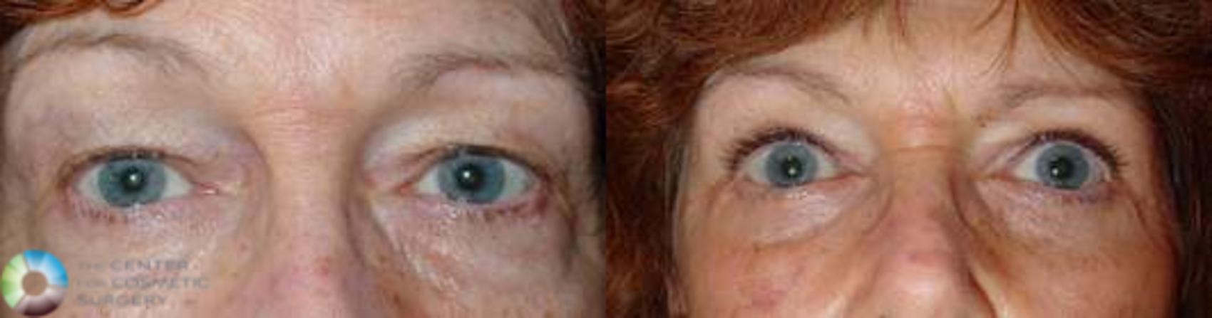 Before & After Eyelid Lift Case 580 View #1 in Denver and Colorado Springs, CO