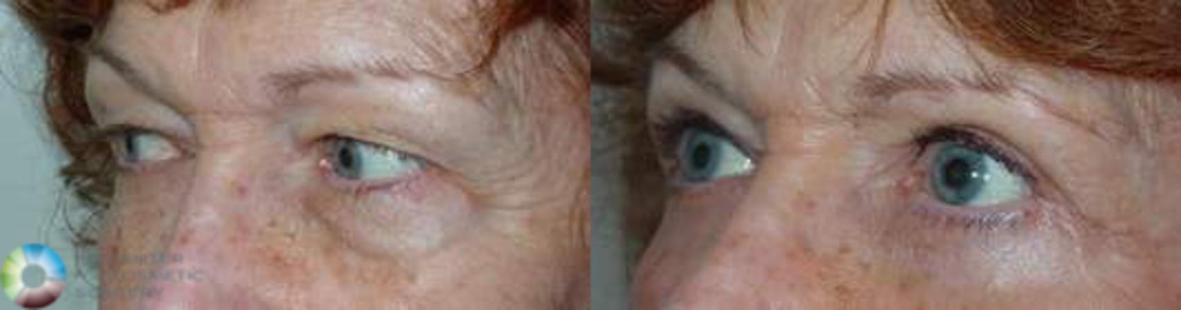 Before & After Eyelid Lift Case 580 View #2 in Denver and Colorado Springs, CO