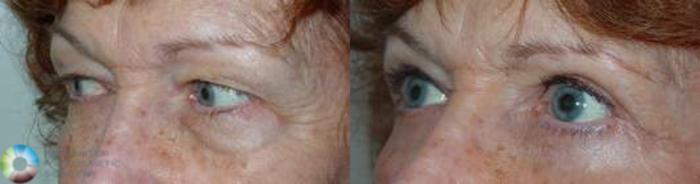 Before & After Eyelid Lift Case 580 View #2 View in Golden, CO