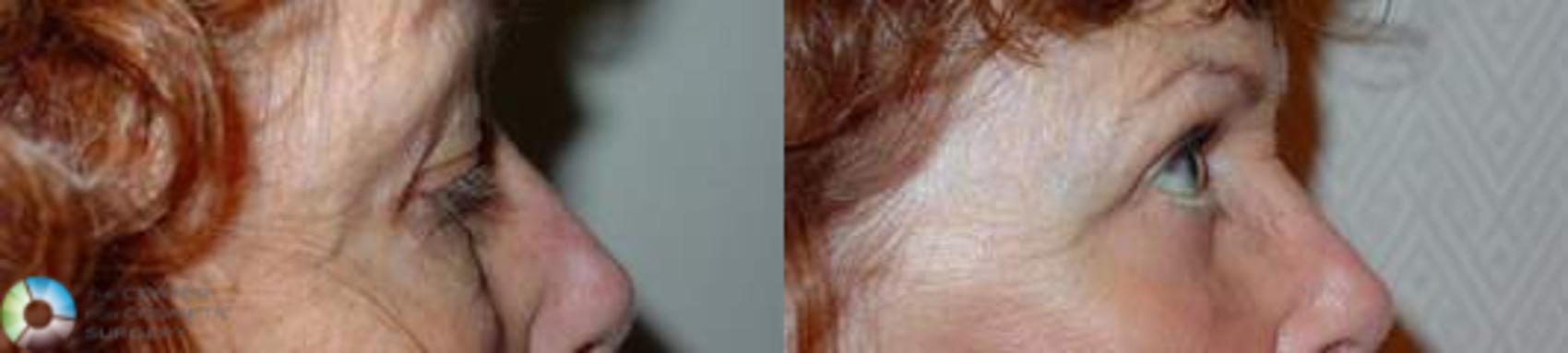 Before & After Eyelid Lift Case 580 View #3 in Denver and Colorado Springs, CO