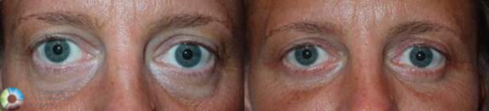 Before & After Eyelid Lift Case 581 View #1 View in Golden, CO