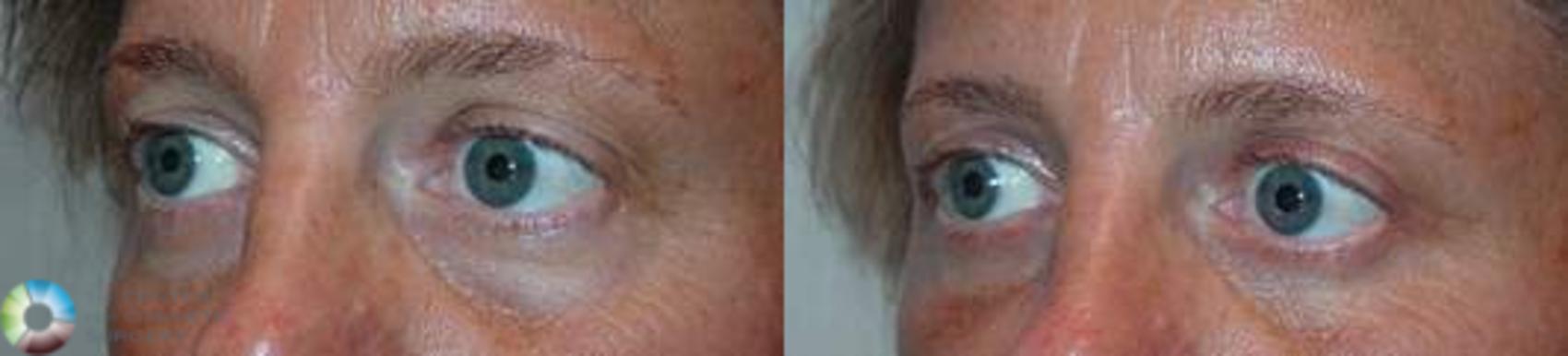 Before & After Eyelid Lift Case 581 View #2 View in Golden, CO