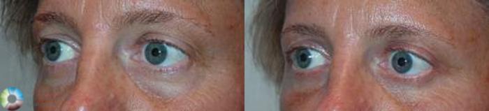 Before & After Eyelid Lift Case 581 View #2 in Denver and Colorado Springs, CO