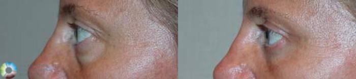 Before & After Eyelid Lift Case 581 View #3 in Denver and Colorado Springs, CO
