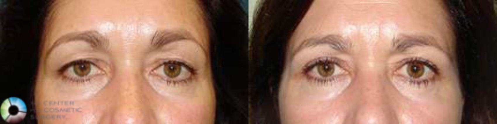 Before & After Eyelid Lift Case 582 View #1 in Denver and Colorado Springs, CO