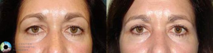 Before & After Eyelid Lift Case 582 View #1 View in Golden, CO